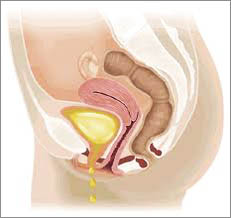 Urine Leakage Incontinence Bladder Surgery India